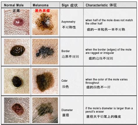 多痣體質|身上多痣是否正常？如何預防與保養？